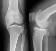 低侵襲人工ひざ関節手術 手術経過レントゲン写真（1）