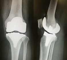 低侵襲人工ひざ関節手術 手術経過レントゲン写真（2）