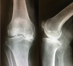 低侵襲人工ひざ関節手術 手術経過レントゲン写真（3）