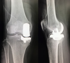 低侵襲人工ひざ関節手術 手術経過レントゲン写真（4）